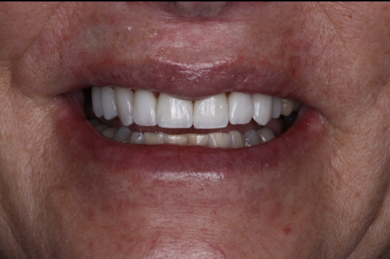 After dental treatment