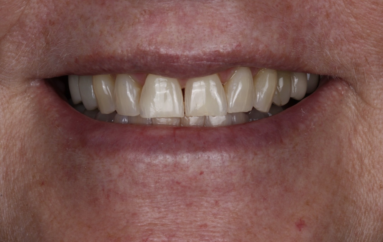 Before dental treatment