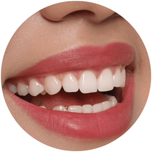 Beautiful smile with dental veneers